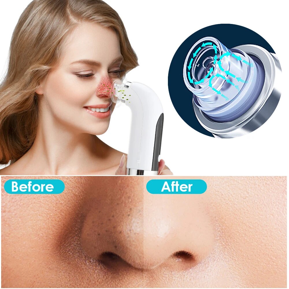 Blackhead Remover Pore Cleaner Vacuum Suction Acne Remover skin care